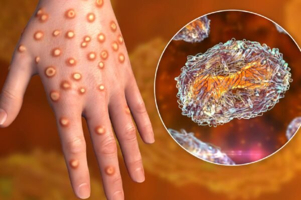 Mpox clade 1b reported in India: All about this monkeypox strain